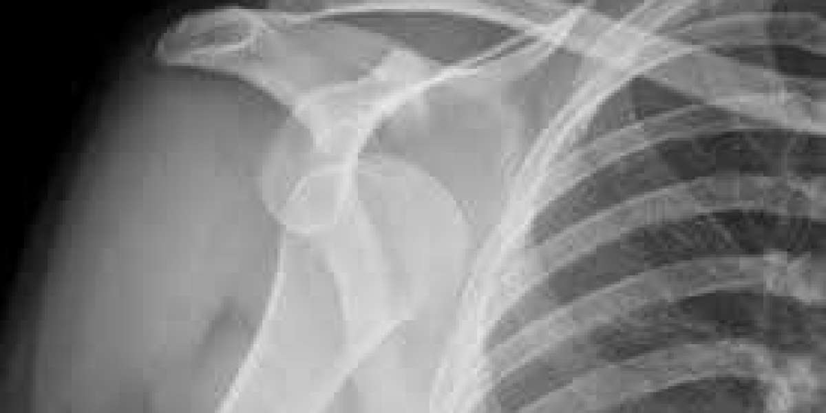 Posterosuperior shoulder dislocation due to the rupture of deltoid posterior fibers