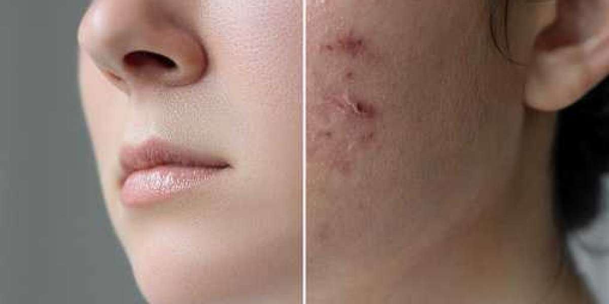 Suffering With Acne? Here Are Some Helpful Solutions!