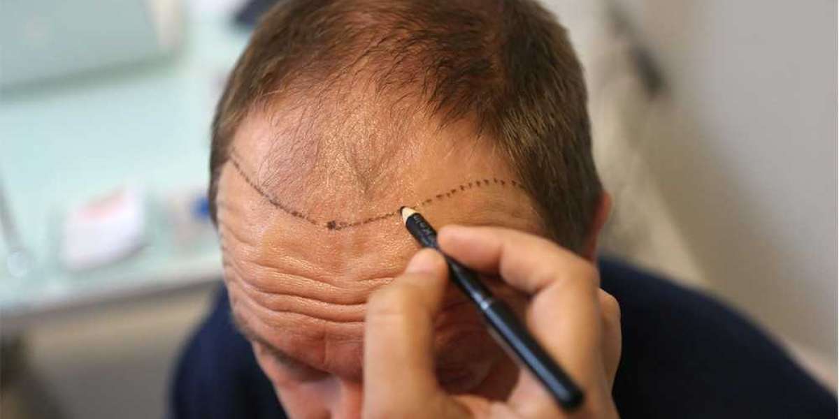 Does The FUE Facial Hair Transplant Works Wonder?