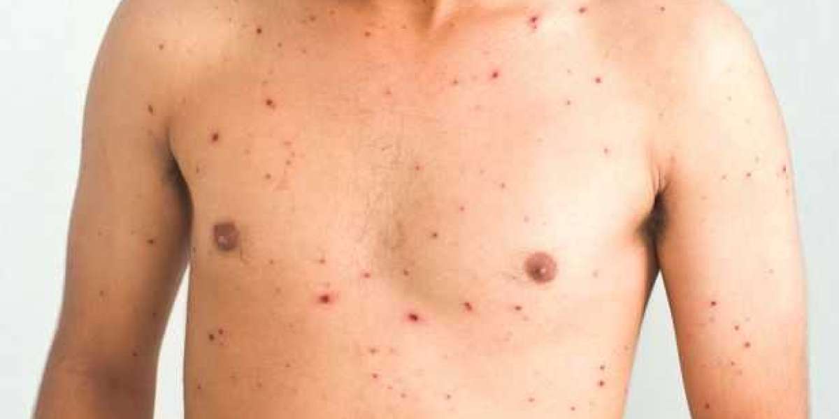 Symptoms of chickenpox in children and whether it is harmful to adults and babies