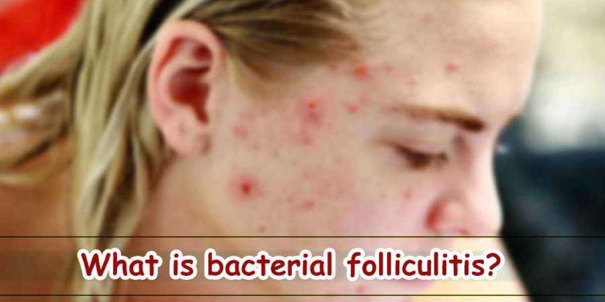 What is bacterial folliculitis?