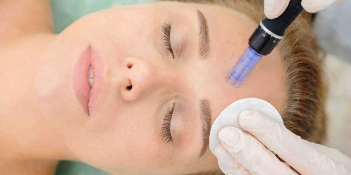 What Makes Microneedling Cost In San Diego Worth The Money