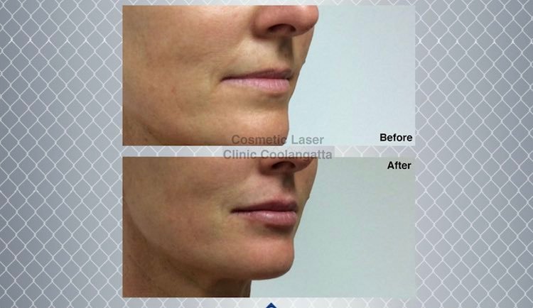 Dermal Fillers: The Safety, Effectiveness, and Longevity Explained - Richbrite